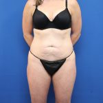 Tummy Tuck Before & After Patient #3063
