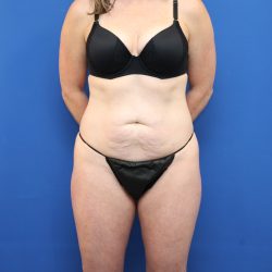Tummy Tuck Before & After Patient #3063
