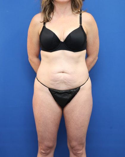 Tummy Tuck Before & After Patient #3063