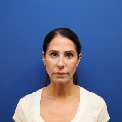 Facelift Before & After Patient #3034