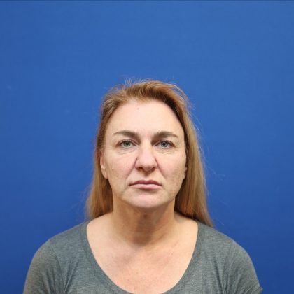 Facelift Before & After Patient #3035