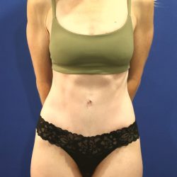 Tummy Tuck Before & After Patient #3033