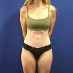 Tummy Tuck Before & After Patient #3033