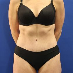 Tummy Tuck Before & After Patient #3063