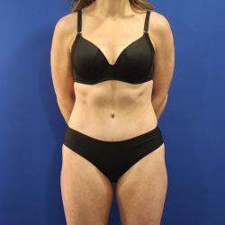 Tummy Tuck Before & After Patient #3063