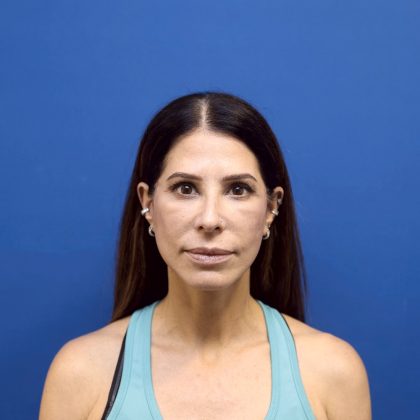 Facelift Before & After Patient #3034