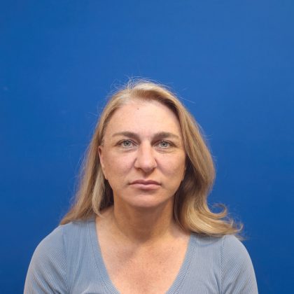 Facelift Before & After Patient #3035