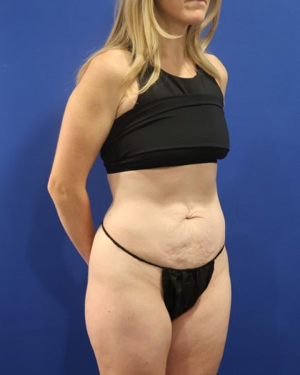 Tummy Tuck Before & After Patient #3033