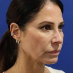 Facelift Before & After Patient #3034