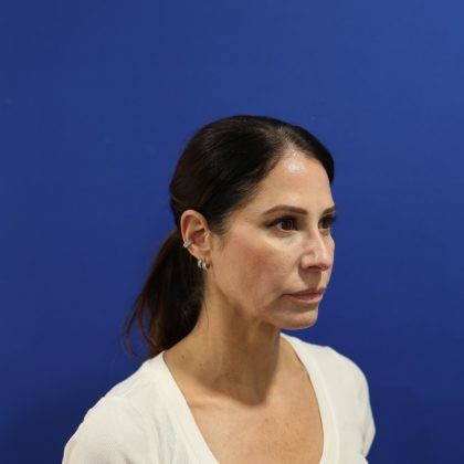 Facelift Before & After Patient #3034