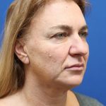 Facelift Before & After Patient #3035