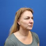 Facelift Before & After Patient #3035