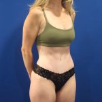 Tummy Tuck Before & After Patient #3033