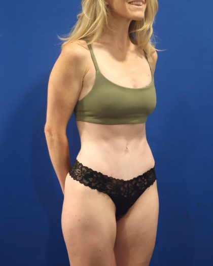 Tummy Tuck Before & After Patient #3033