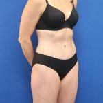 Tummy Tuck Before & After Patient #3063