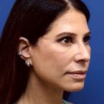 Facelift Before & After Patient #3034