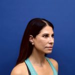 Facelift Before & After Patient #3034