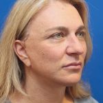 Facelift Before & After Patient #3035