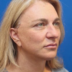 Facelift Before & After Patient #3035