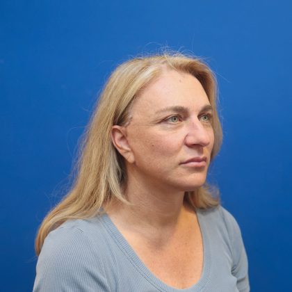 Facelift Before & After Patient #3035