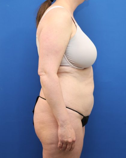 Tummy Tuck Before & After Patient #3064