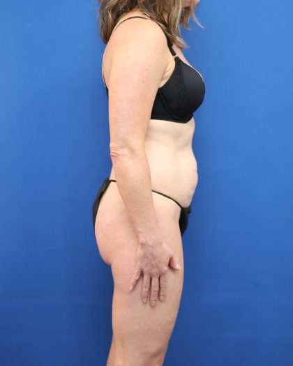 Tummy Tuck Before & After Patient #3063