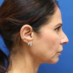 Facelift Before & After Patient #3034
