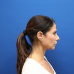 Facelift Before & After Patient #3034
