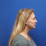 Facelift Before & After Patient #3035