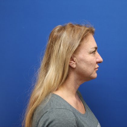 Facelift Before & After Patient #3035