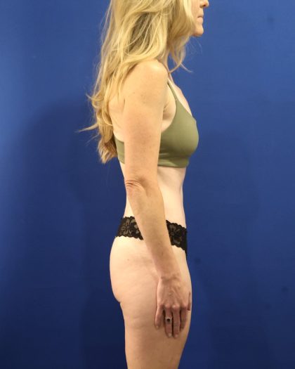 Tummy Tuck Before & After Patient #3033