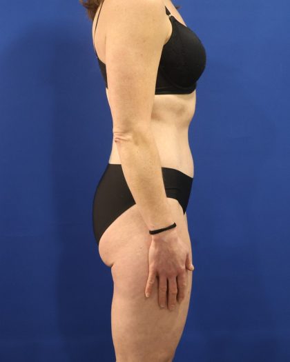 Tummy Tuck Before & After Patient #3063