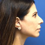 Facelift Before & After Patient #3034