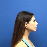 Facelift Before & After Patient #3034
