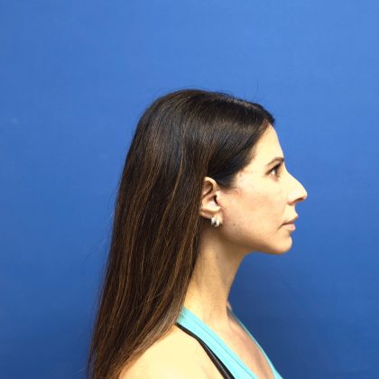 Facelift Before & After Patient #3034
