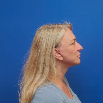 Facelift Before & After Patient #3035