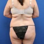Tummy Tuck Before & After Patient #3064