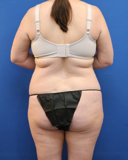 Tummy Tuck Before & After Patient #3064