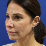 Facelift Before & After Patient #3034