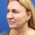 Facelift Before & After Patient #3035