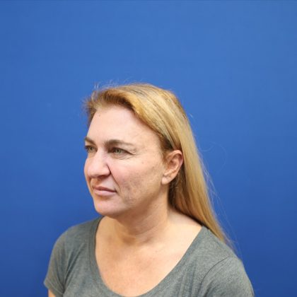 Facelift Before & After Patient #3035