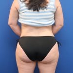 Tummy Tuck Before & After Patient #3064