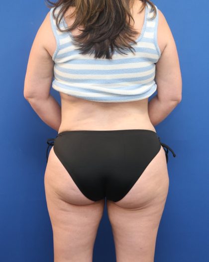 Tummy Tuck Before & After Patient #3064