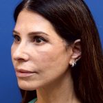 Facelift Before & After Patient #3034