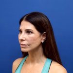 Facelift Before & After Patient #3034