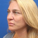 Facelift Before & After Patient #3035