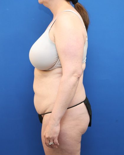 Tummy Tuck Before & After Patient #3064