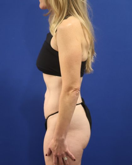 Tummy Tuck Before & After Patient #3033