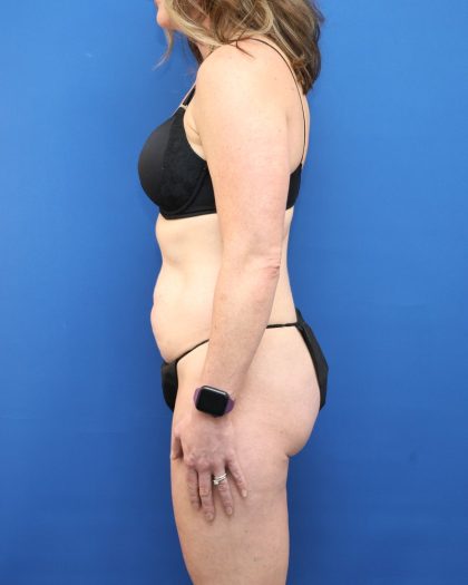 Tummy Tuck Before & After Patient #3063