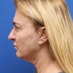 Facelift Before & After Patient #3035